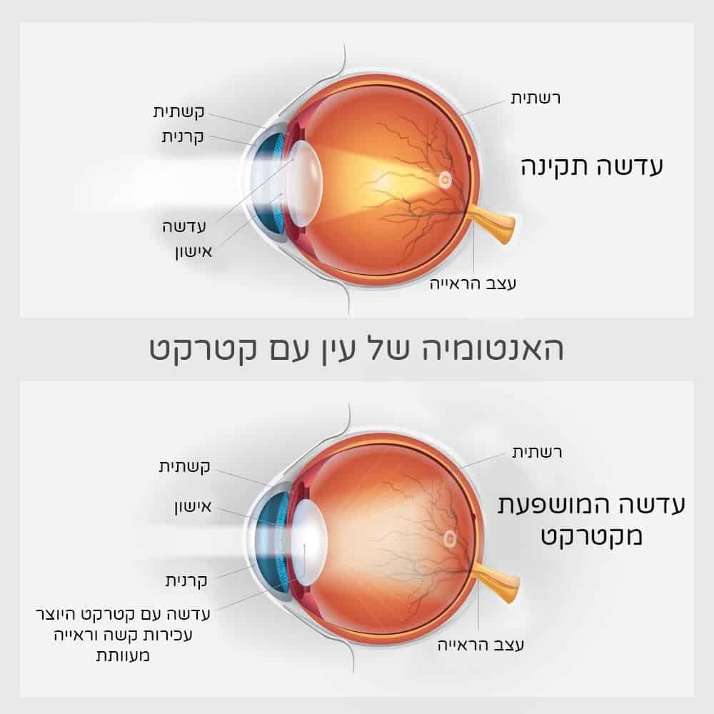 קטרקט