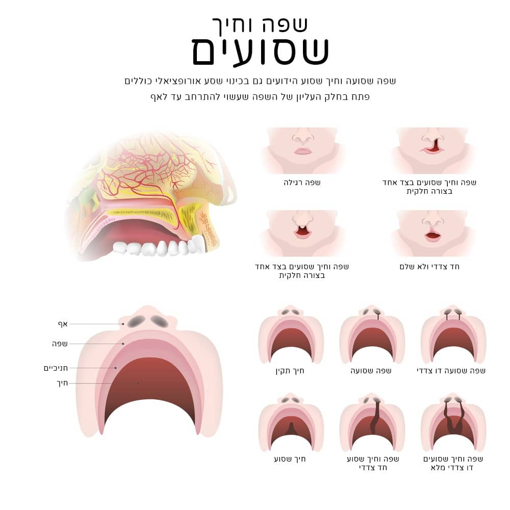 מידע לגבי שפה וחיך שסועים