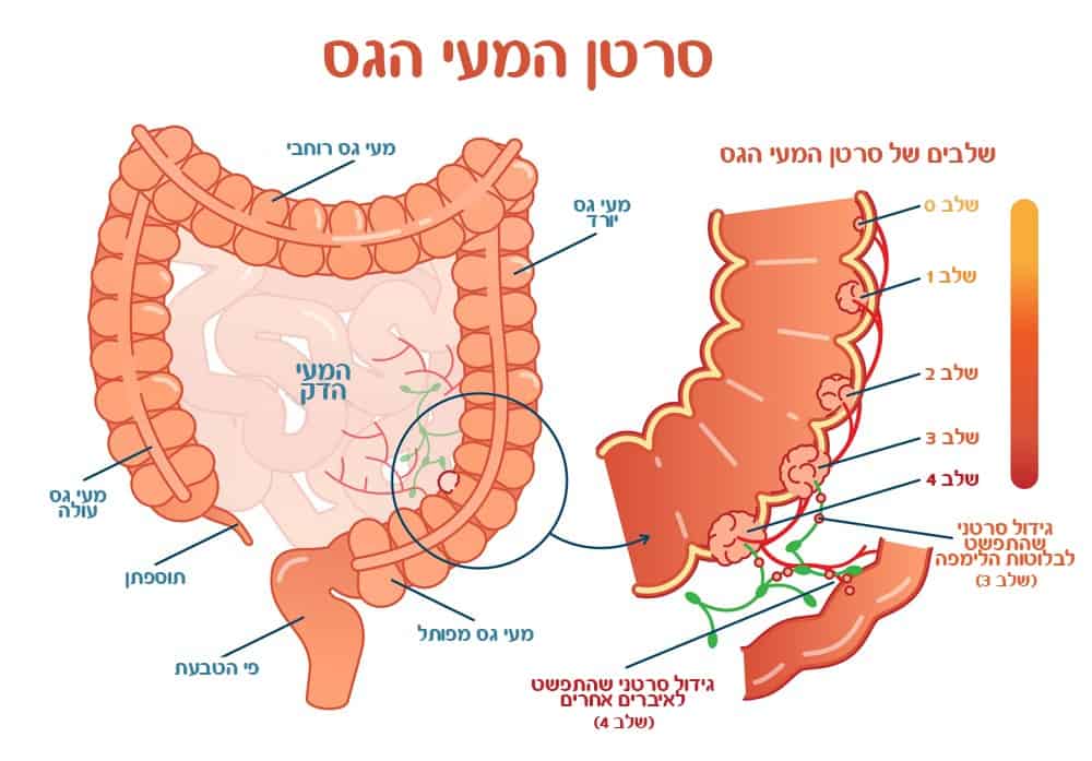 שלבים של סרטן המעי הגס