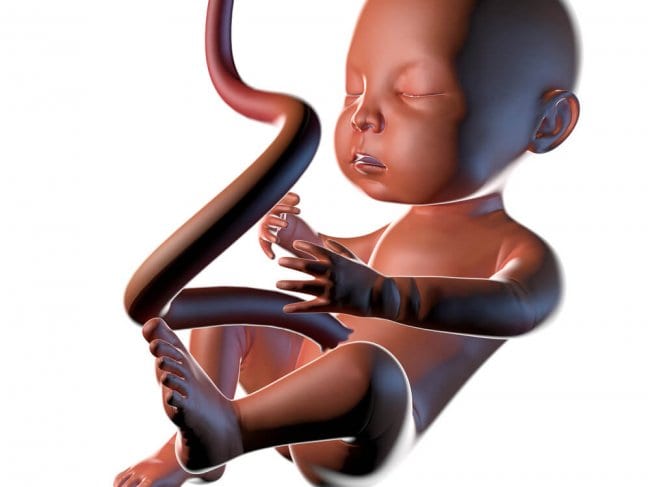 רשלנות רפואית באבחון סיבוכים בחבל הטבור