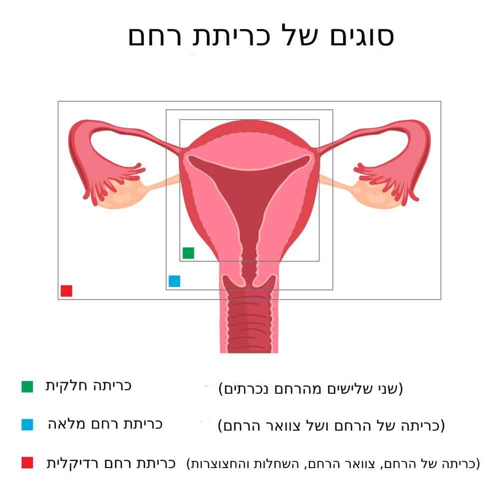 סוגים של כריתת רחם