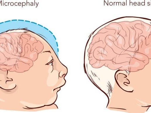 מיקרוצפליה