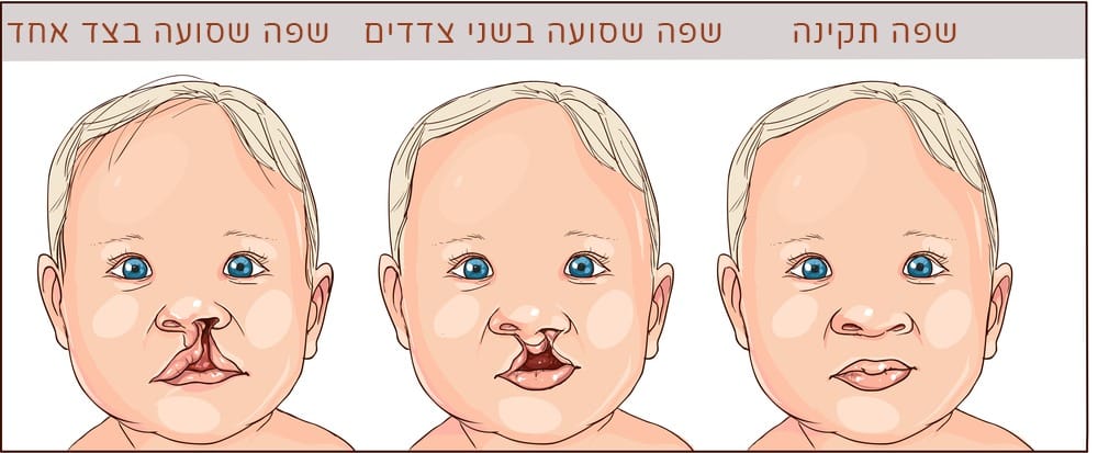 סוגים של שפה שסועה