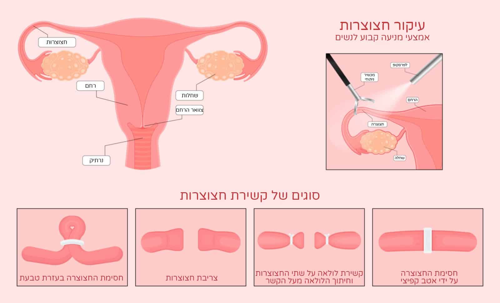 סוגי ניתוחים לקשירת חצוצרות