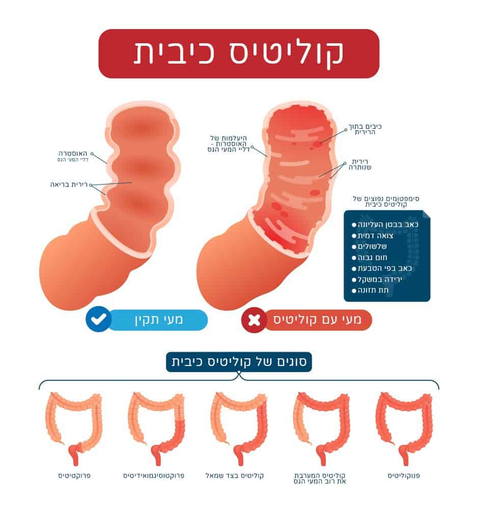 קוליטיס כיבית