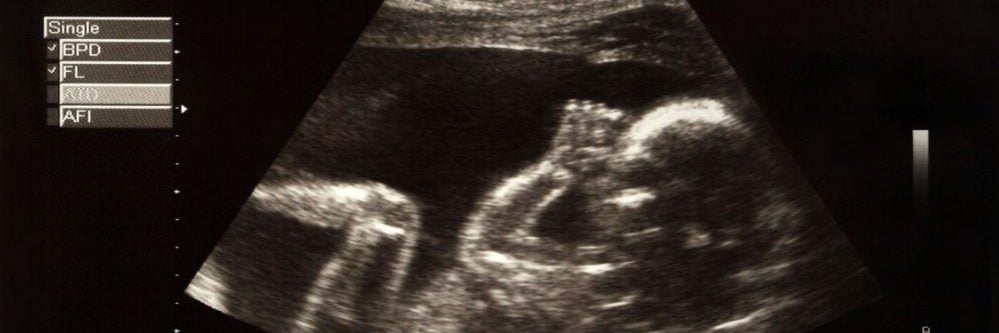 הולדה בעוולה