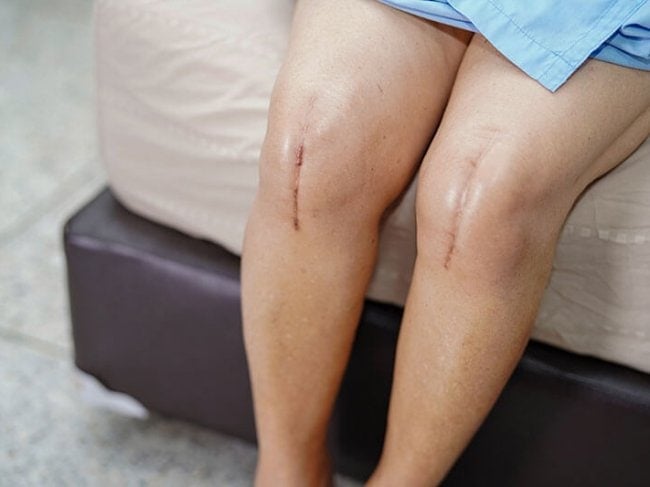 צלקת מניתוח