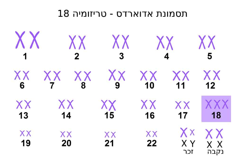 טריזומיה 18 בבדיקות