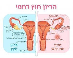 הריון רגיל מול הריון חוץ רחמי