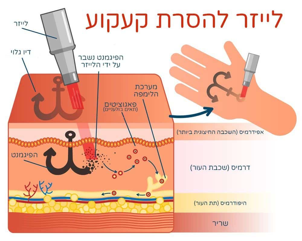 כיצד פועל לייזר להסרת קעקוע
