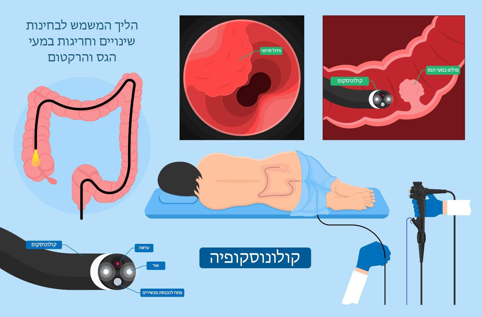 בדיקת קולונוסקופיה