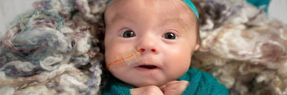 תינוק עם טריזומיה 18