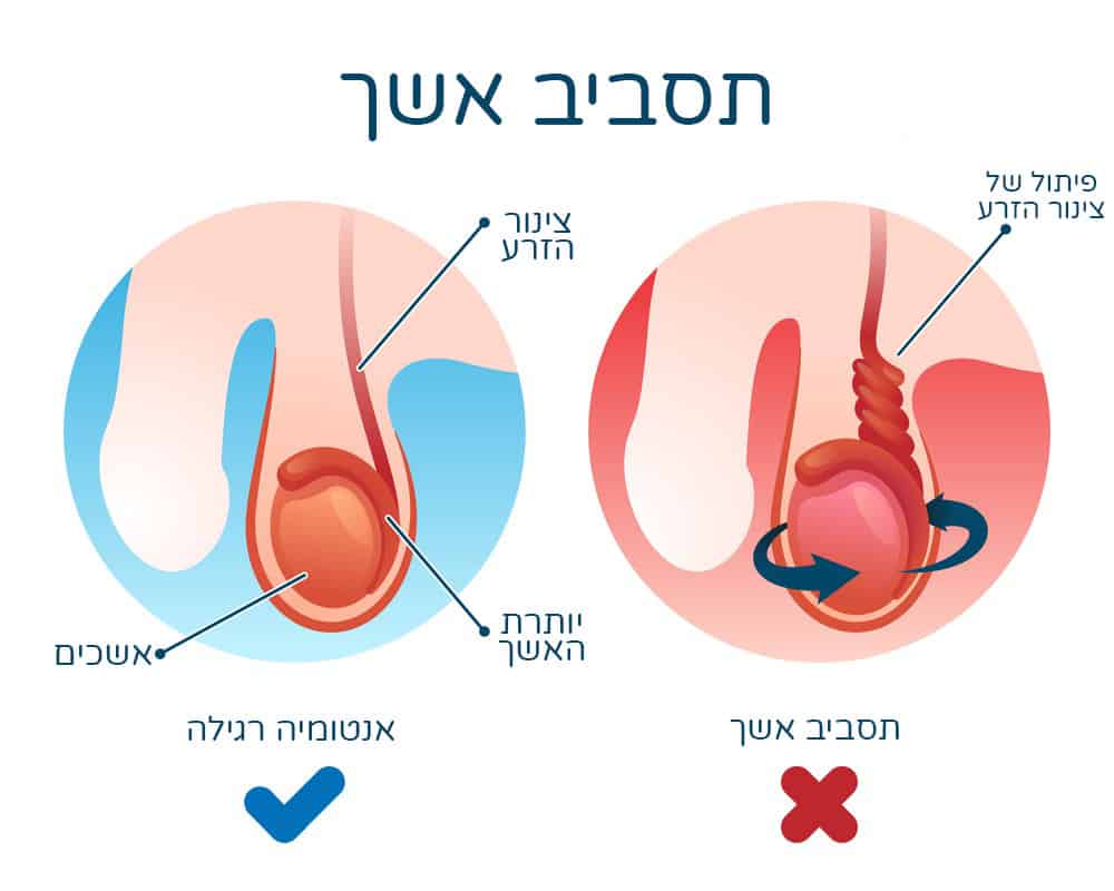 איך נראה תסביב אשך