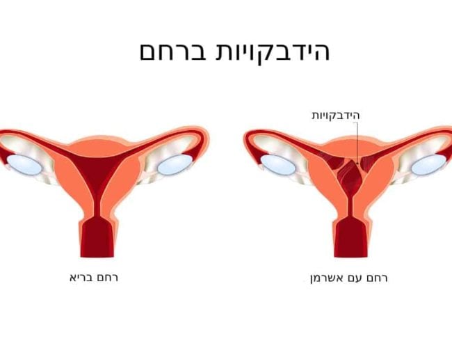 תסמונת אשרמן