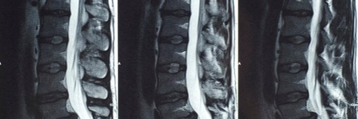 תסמונת זנב הסוס